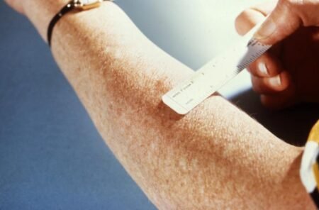 Detectan casos de tuberculosis en National City