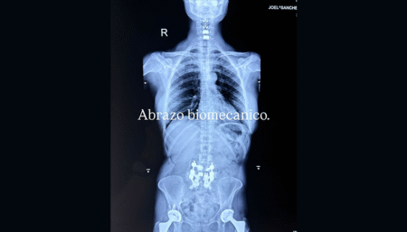 Alejandra Guzmán impacta al mostrar radiografía de su columna tras nueva cirugía