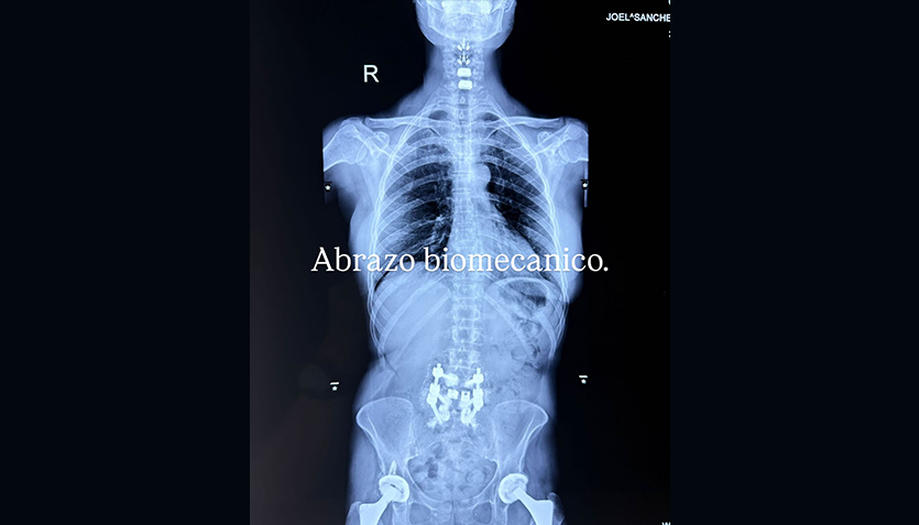 Alejandra Guzmán impacta al mostrar radiografía de su columna tras nueva cirugía